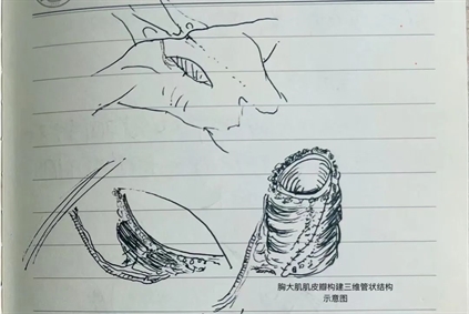 医疗技术丨北京大学肿瘤医院云南医院 云南省肿瘤医院成功开展利用胸大肌皮瓣创新性修复局晚期下咽癌全喉全下咽切除术后环周缺损重建术